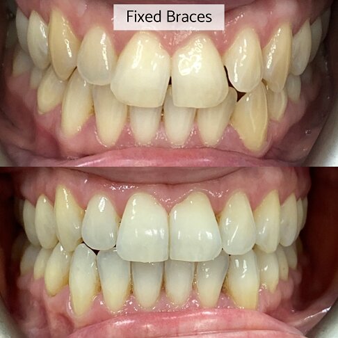Fixed braces cost London