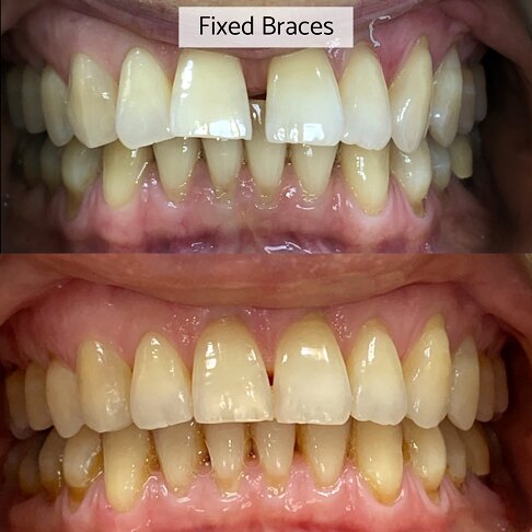 Fixed braces cost in London