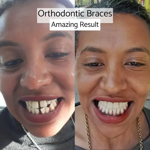 Fixed braces – before and after results