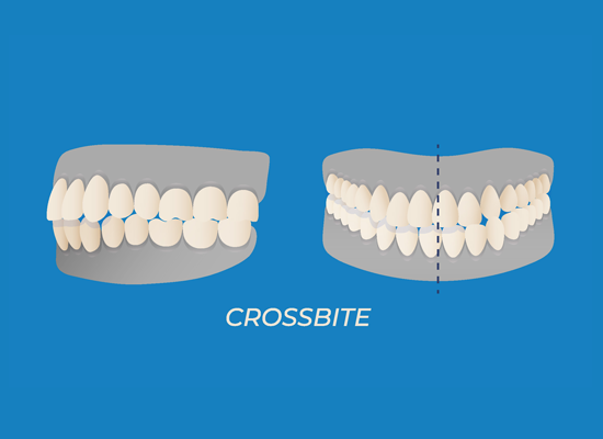 Crossbite teeth
