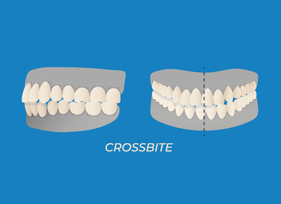 diagram of crossbite alignment issue
