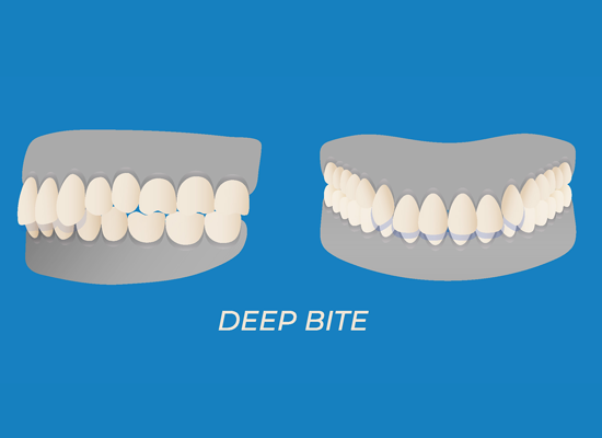 Deepbite teeth