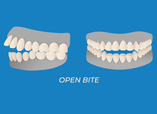diagram of openbite alignment problem