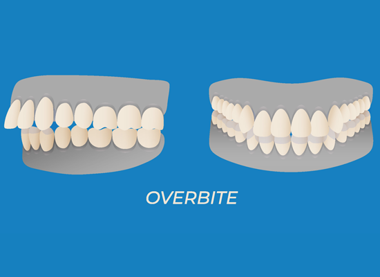 Overbite teeth