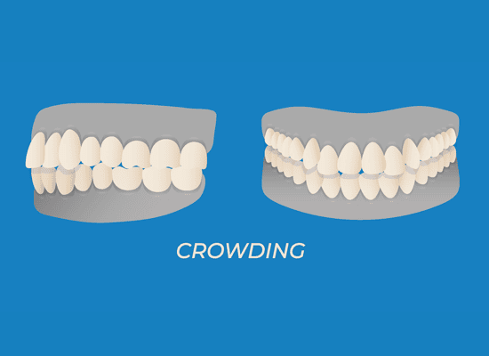 diagram of overcrowded teeth