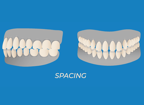 Gapping teeth