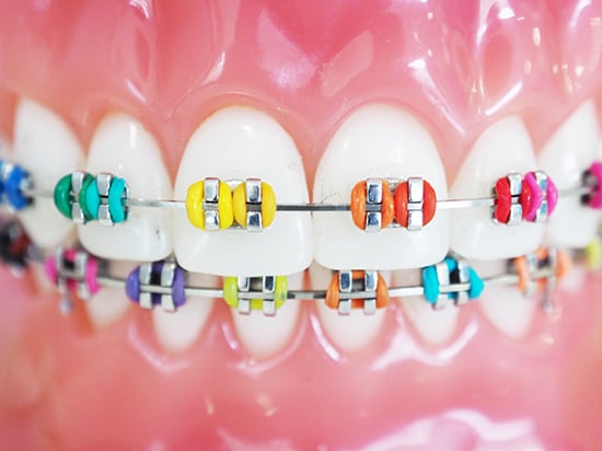 photo of multi-coloured teeth braces