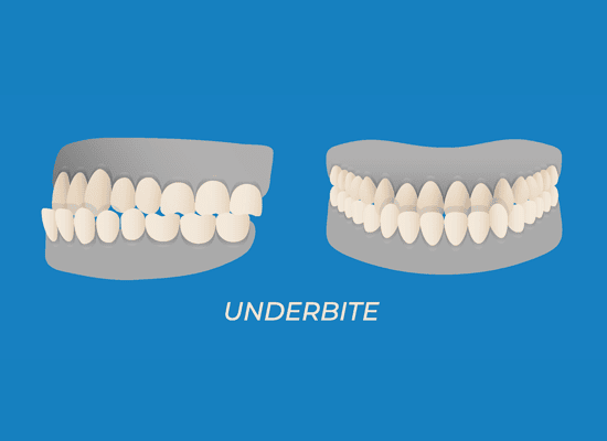 diagram of underbite