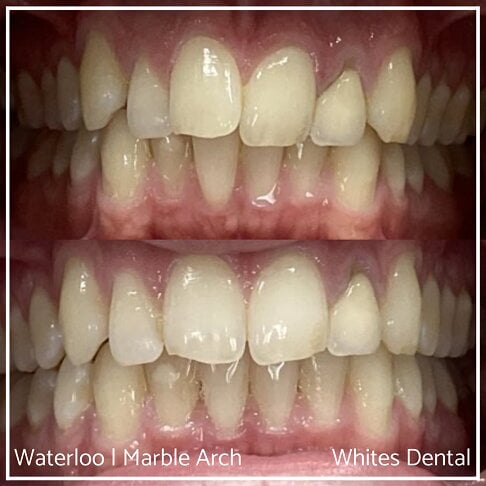 Braces Before And After - photo of teeth - front - crowded teeth