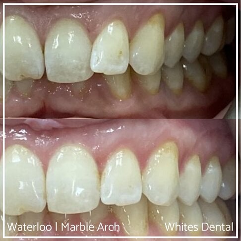 Braces Before And After, Adult Braces for misaligned teeth