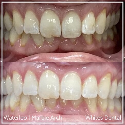 Braces Before And After Overlapping Teeth Adult Braces