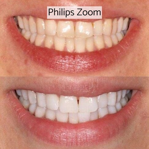 In-clinic Zoom laser light teeth whitening London - before and after 4