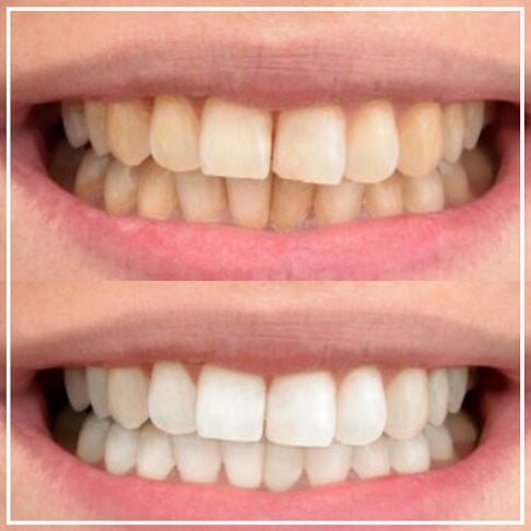 Philips Zoom Home Teeth Whitening patient photo - Before And After