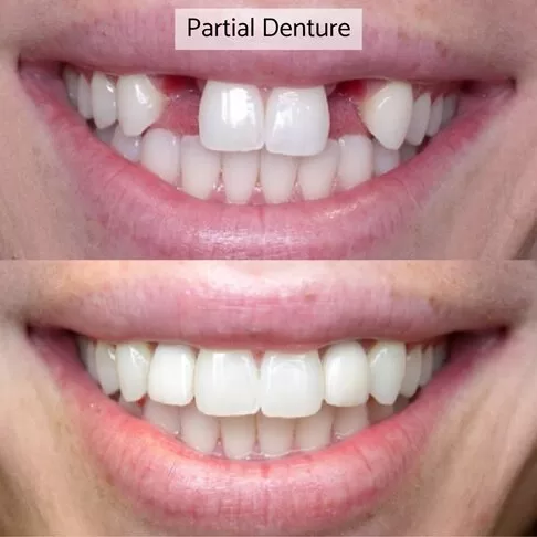 photo of front teeth partial dentures - before and after