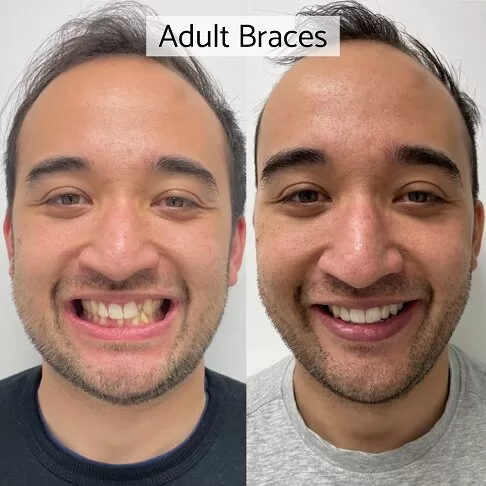 Adult Braces