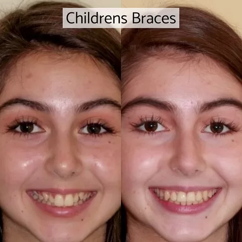 Children Braces