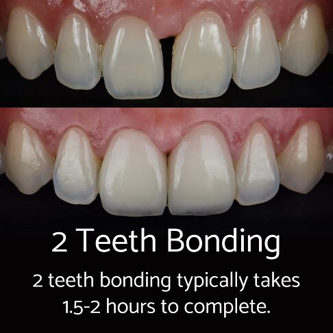 2 teeth composite bonding takes 90 to 120 minutes to complete