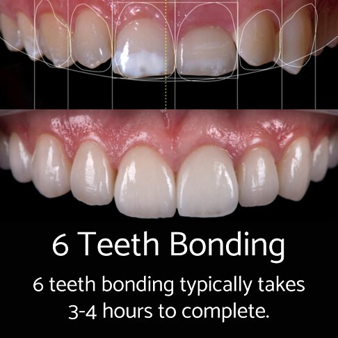 6 teeth composite bonding takes 3 to 4 hours to complete