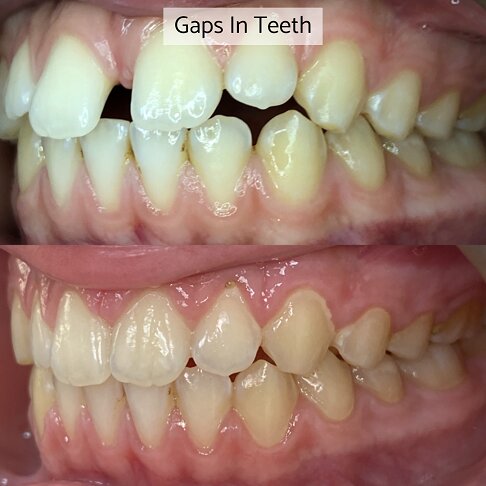 Before after photo of a case where Invisalign was used to close gaps between teeth 2