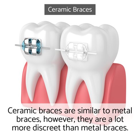 Ceramic braces London are more discreet than traditional braces