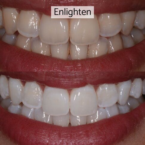 Enlighten whitening London - before and after 2