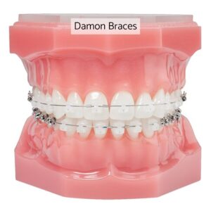 Photo of damon braces with clear brackets