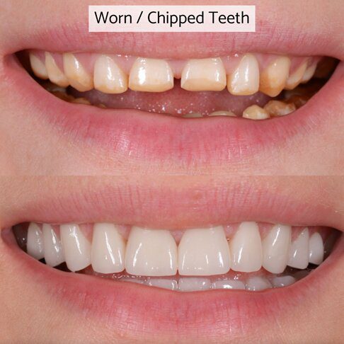 Veneers Cost In London - fixing worn out or chipped teeth