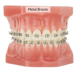 orthodontist photo and model of metal braces