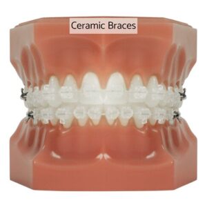 Photo of fixed braces with ceramic brackets