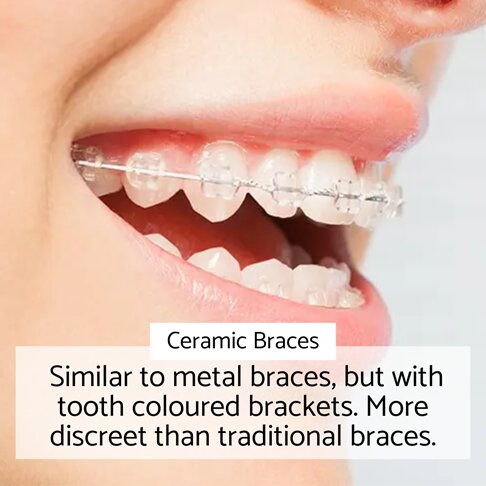 Ceramic Braces