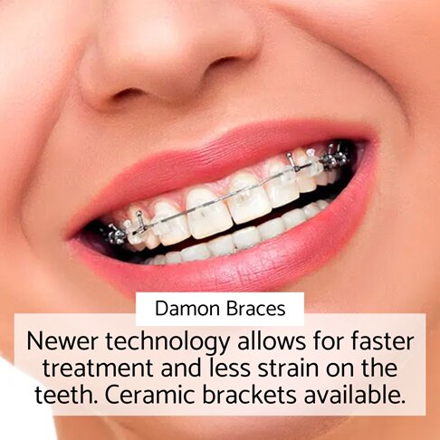 Damon Braces