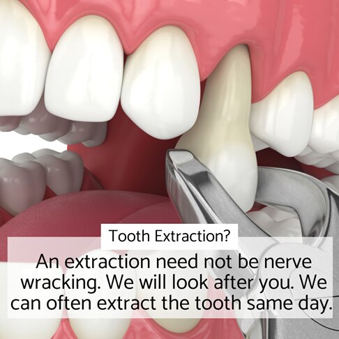 Image of a tooth extraction at our Emergency Dentist in London