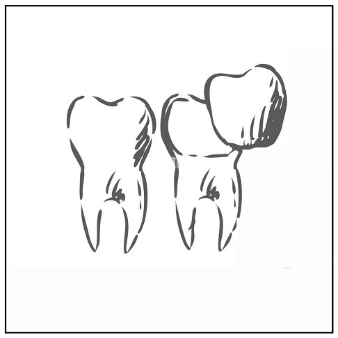 Veneers London Marble Arch W2 and Paddington 2