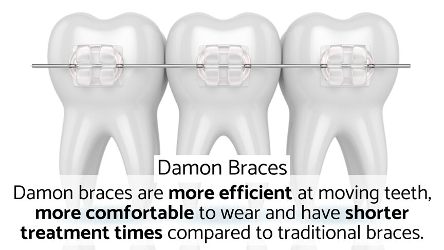Damon Braces London - braces showing newer Damon technology