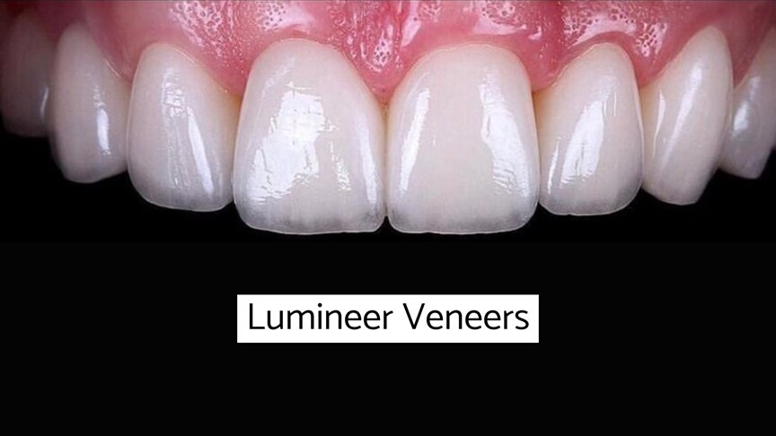 Dental Lumineers in London - full set of teeth lumineers