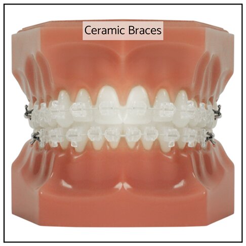 Fixed Ceramic Braces