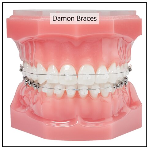 Fixed Damon Braces