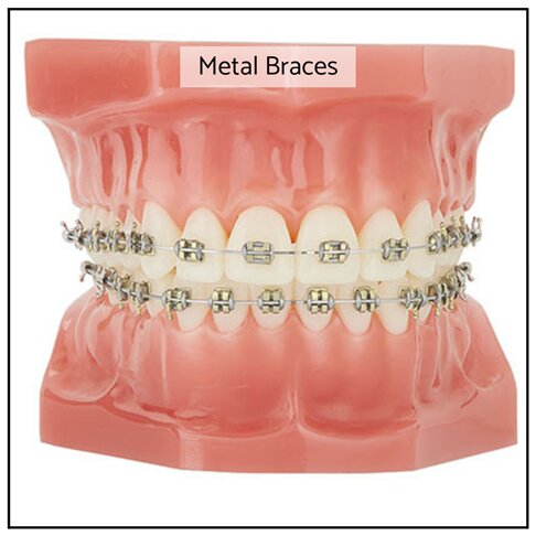 Fixed Metal Braces