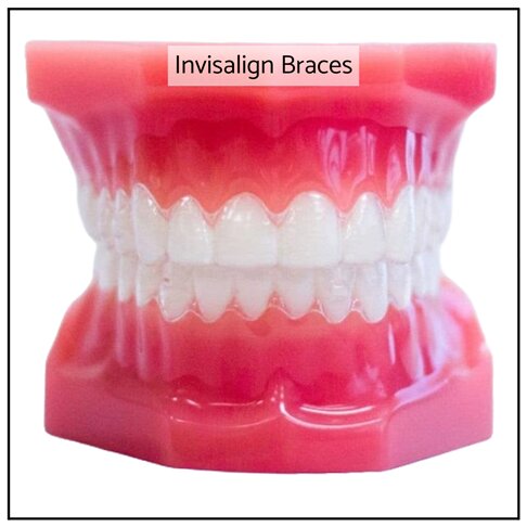 Invisalign Clear Braces