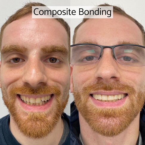 Is composite bonding worth it - image of man showing excellent bonding results