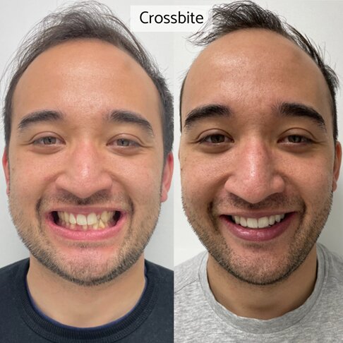 Metal braces London - before after braces