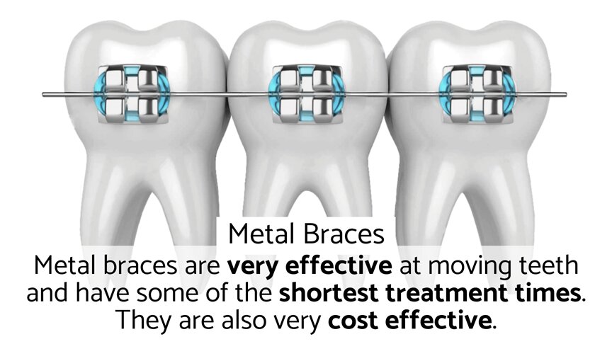 Metal braces London - why metal braces