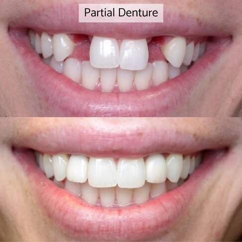 Partial Dentures London - before and after