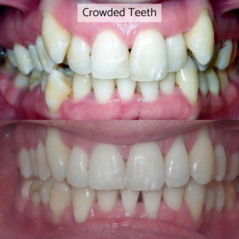 Dental Braces London - crooked crowded teeth can be fixed with dental braces