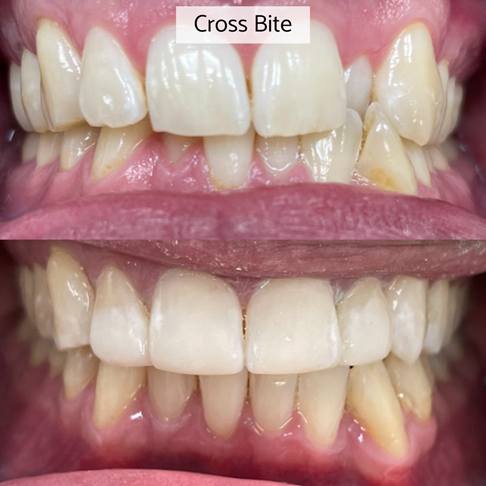 Dental Braces London - crossbite openbite underbite overbite can be fixed with dental braces