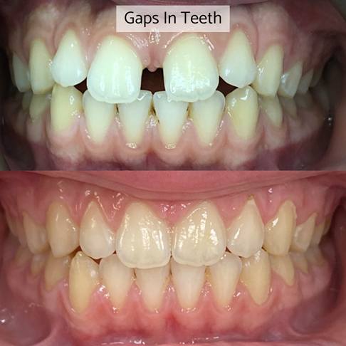 Dental Braces London - gaps in teeth can be fixed with dental braces