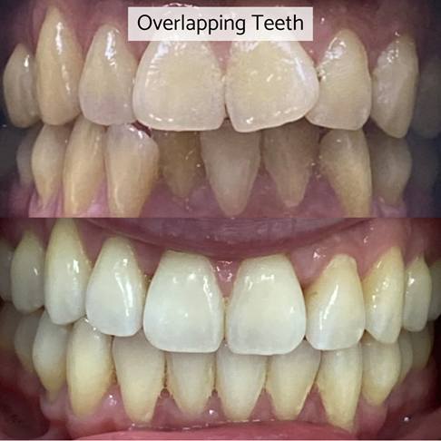 Dental Braces London - overlapping teeth can be fixed with dental braces