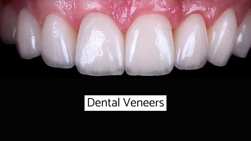 Dental Veneers London