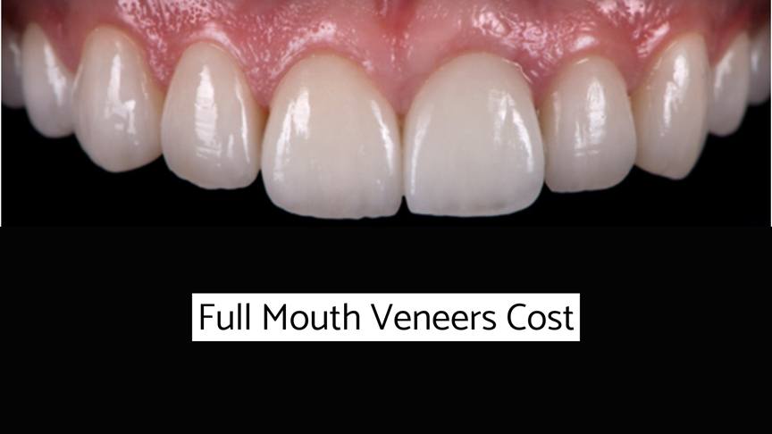Full Mouth Veneers Cost - how much do full mouth veneers cost