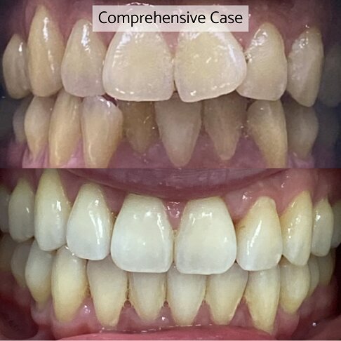 Invisalign London - Full or Comprehensive Package